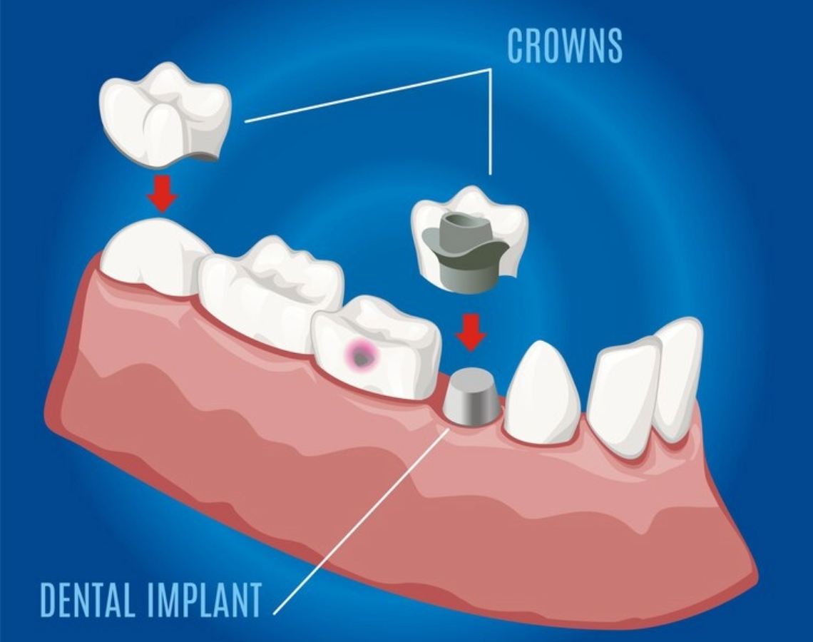 Crown and Bridge Treatment in Hanamkonda, Warangal