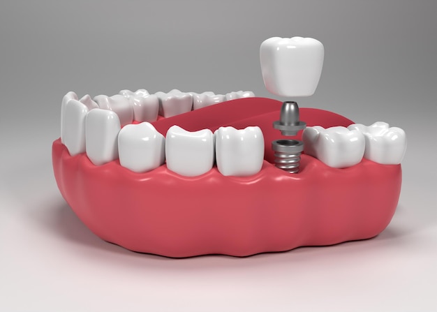 Dental Implants in Hanamkonda, Warangal