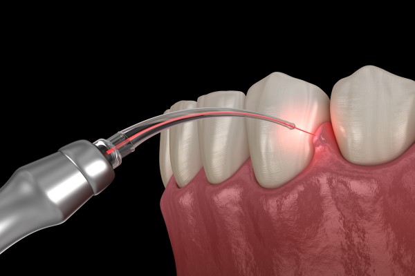 Laser Dentistry in Hanamkonda, Warangal