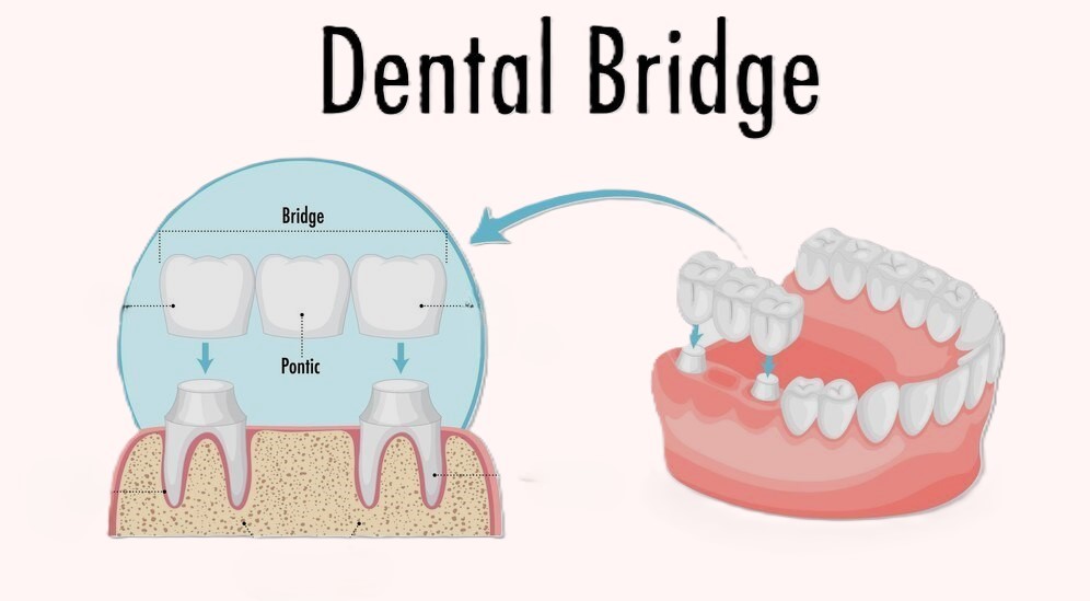 Dental crowns and bridges