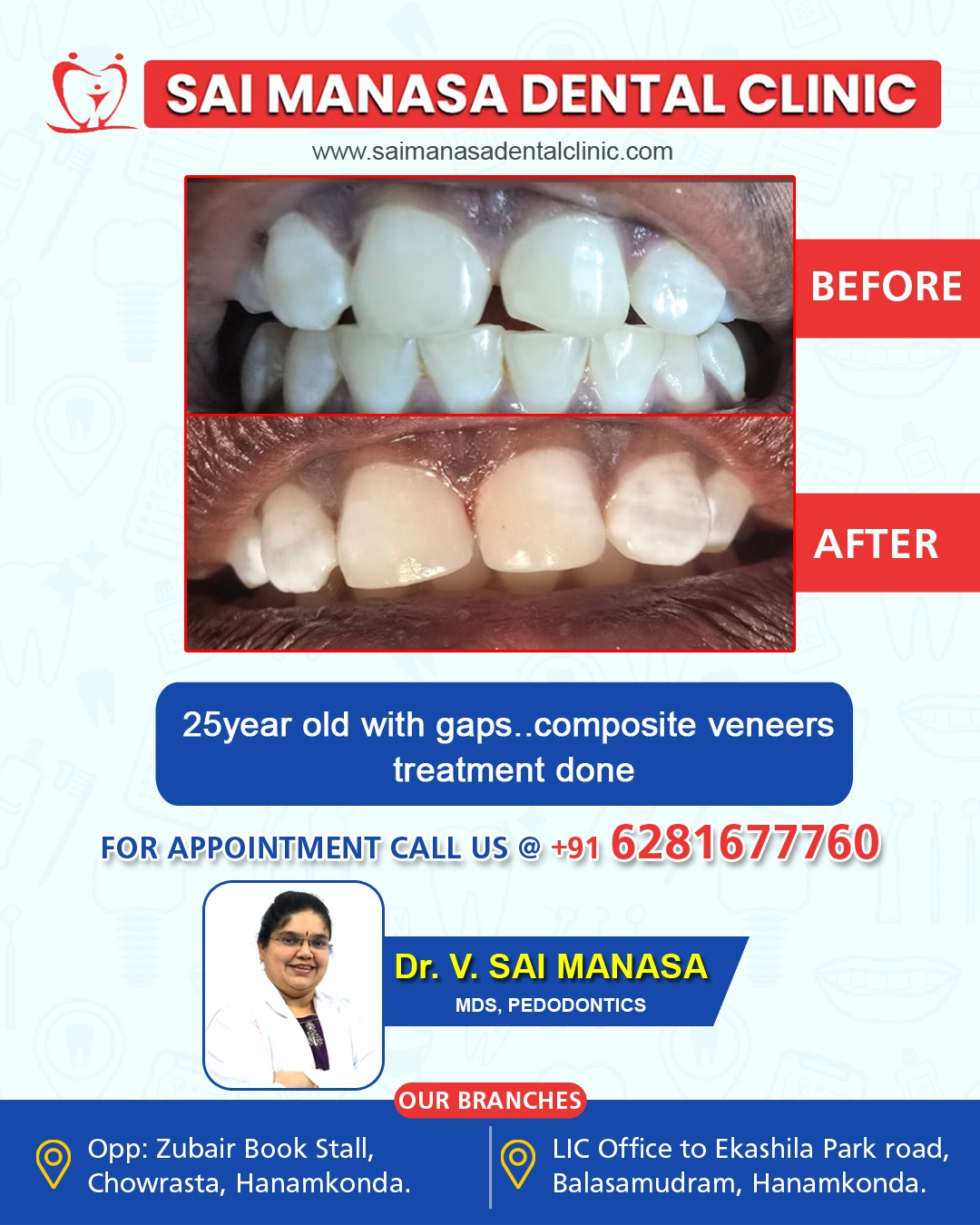 Before and after composite veneers