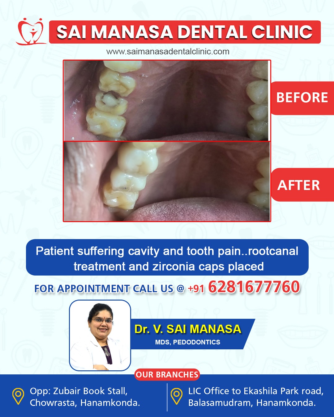 Root canal and zirconia treatment