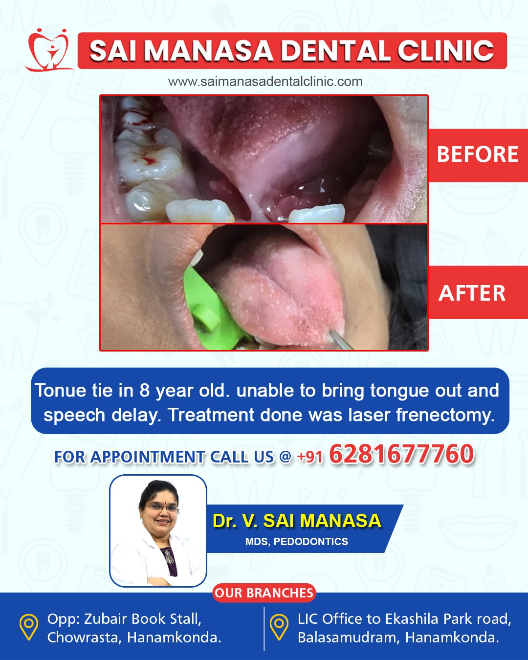 Laser frenectomy treatment