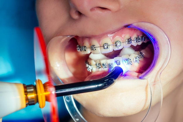 Orthodontic dental treatment